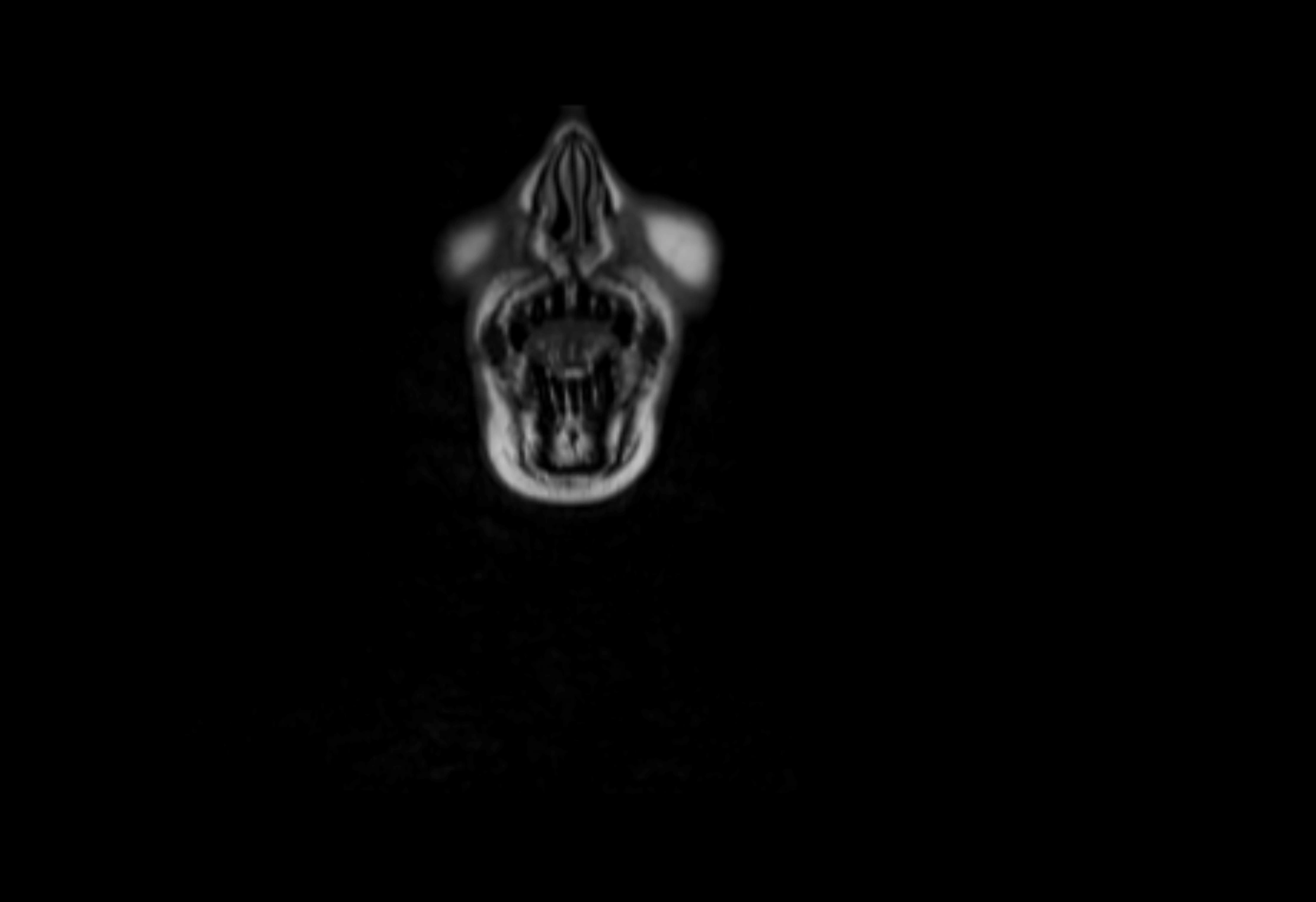 Neck coronal lymph node cross sectional MRI anatomy 3T MRI  image-img-00001-00075.webp